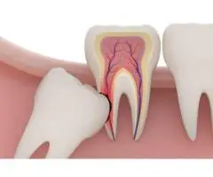 Dental Veneers in Canberra