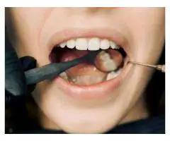 Transform Your Smile with Premium Dental Veneers in Philadelphia by My Smile For Life