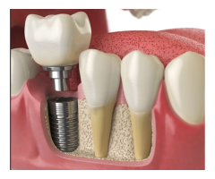 Restore Your Smile with Dental Implants Trusted Tooth Implant Solutions