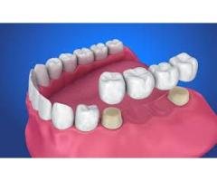 Restore Your Smile with Expert Crowns & Bridges in Canada Milestone Dentistry - 2
