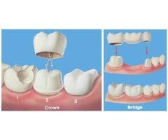 Restore Your Smile with Expert Crowns & Bridges in Canada Milestone Dentistry - 3