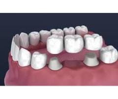 Restore Your Smile with Expert Crowns & Bridges in Canada Milestone Dentistry - 4