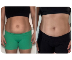 Non-Surgical Fat Freezing Windsor Experts