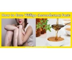 AROGYAM PURE HERBS KIT FOR VITILIGO