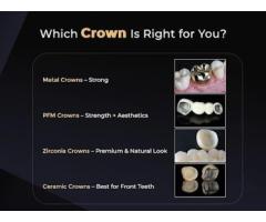 Best Dental Crown Treatment in Madinaguda FMS Dental