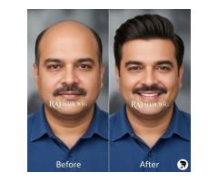 Hair Patch in Delhi Non-Surgical Hair Solutions