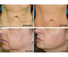 NewMe Clinic and Wellness Best Dietician Diet Plan for Weight Loss and Gain Nutritionist in Airoli - 4