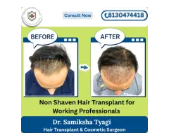 Hair Transplant Clinic in Noida Naturally Restore Your Hair - 2