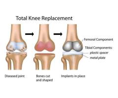 Total Knee Replacement Surgery in Mumbai Divi Orthopaedic