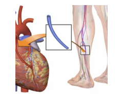 Aortic Valve Replacement Surgery Cost Bangalore MICS