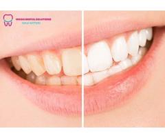 Best and Affordable Smile Makeover Treatment In Noida Noida Dental Solutions - 2