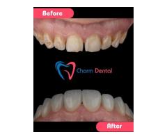 Invisalign & Cosmetic Dentistry in Katy, TX Get Your Dream Smile