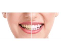 Professional Teeth Whitening Philly Services Helping Patients Achieve Brighter Confident Smiles