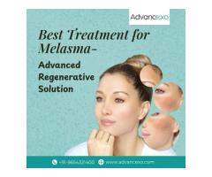 Best Treatment for Melasma - Advanced Regenerative Solution