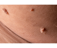 Skin Tag Removal Maidenhead - Call us