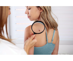 Skin Tag Removal Maidenhead - Call us - 3