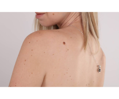 Skin Tag Removal Maidenhead - Call us - 4