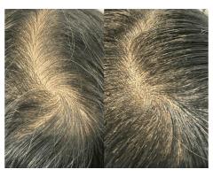 Hairline Restoration with Scalp Micropigmentation Vancouver