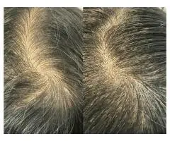 Hairline Restoration with Scalp Micropigmentation Vancouver