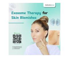 Exosome Therapy for Skin Blemishes