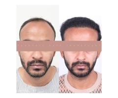 Best Hair Transplant Indore Advanced Hair Restoration with Natural Results