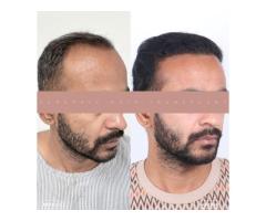 Best Hair Transplant Indore Advanced Hair Restoration with Natural Results - 2