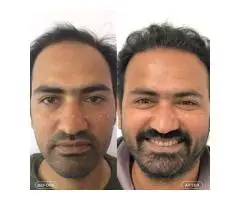 Best Hair Transplant Indore Advanced Hair Restoration with Natural Results - 3