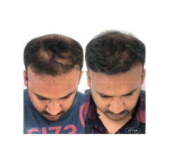 Best Hair Transplant Indore Advanced Hair Restoration with Natural Results - 5