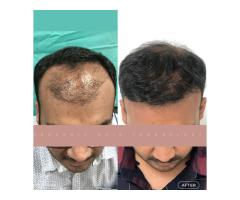 Best Hair Transplant Indore Advanced Hair Restoration with Natural Results - 6