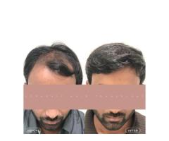 Best Hair Transplant Indore Advanced Hair Restoration with Natural Results - 7
