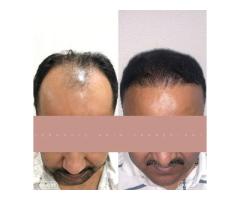 Best Hair Transplant Indore Advanced Hair Restoration with Natural Results - 8