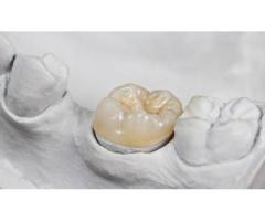 Dental Inlay, Onlay, Fillings, or Crowns Which is Best for You