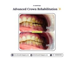Advanced Crown Rehabilitation In Gurgaon Dr. Anukriti Gupta Gurgaon