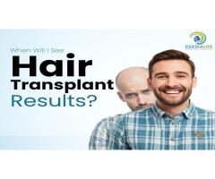 Hair Transplant Cost in Delhi Starts 50,000 Best Clinic Dermalife