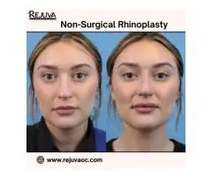 Non-surgical Rhinoplasty Newport Beach for Natural Enhancement