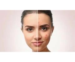 Acne Scar Removal Delhi for Clear and Smooth Skin