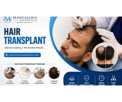 Hair Transplant in Varanasi High Density & Permanent Results - 3