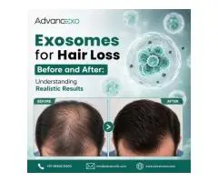 Exosomes for Hair Loss Before and After Understanding Realistic Results