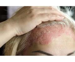 Eczema Rash Treatment Expert Care for Healthy Skin