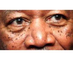 Dermatosis Papulosa Nigra Treatment Tampa Experts