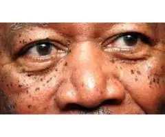 Dermatosis Papulosa Nigra Treatment Tampa Experts