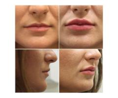 Lip Fillers Cherry Creek