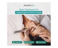 Best Treatment for Hyperpigmentation Guide