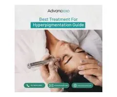 Best Treatment for Hyperpigmentation Guide