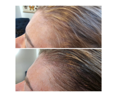 Scalp Tattoo Near Me Scalp Micropigmentation Experts