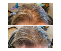 Scalp Tattoo Near Me Scalp Micropigmentation Experts - 2