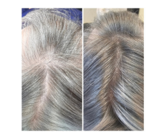 Scalp Tattoo Near Me Scalp Micropigmentation Experts - 3