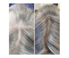 Scalp Tattoo Near Me Scalp Micropigmentation Experts - 3