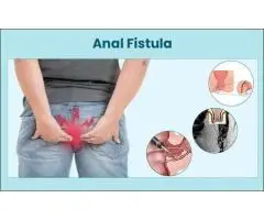 Permanent Relief with Expert Ayurvedic Piles & Fissure Care in Delhi
