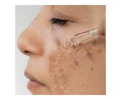Hyperpigmentation Treatment Tampa for Radiant Skin